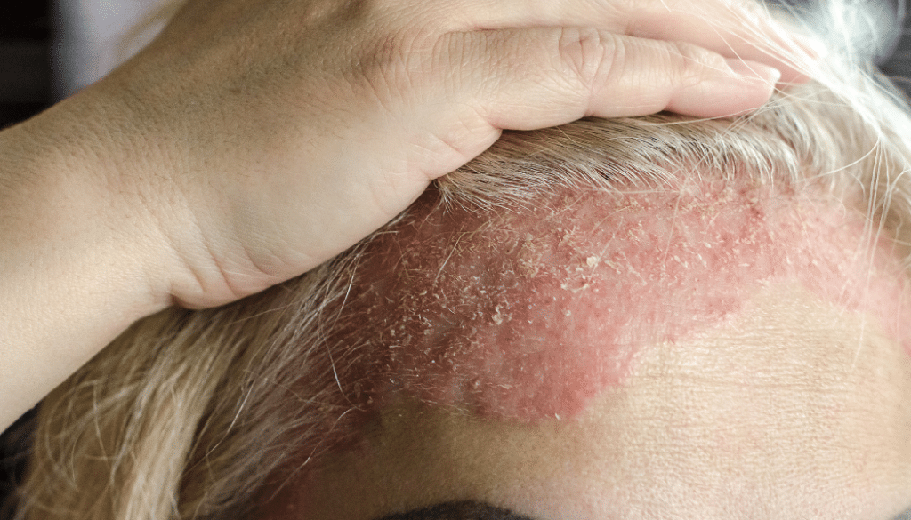 huile de cade psoriasis